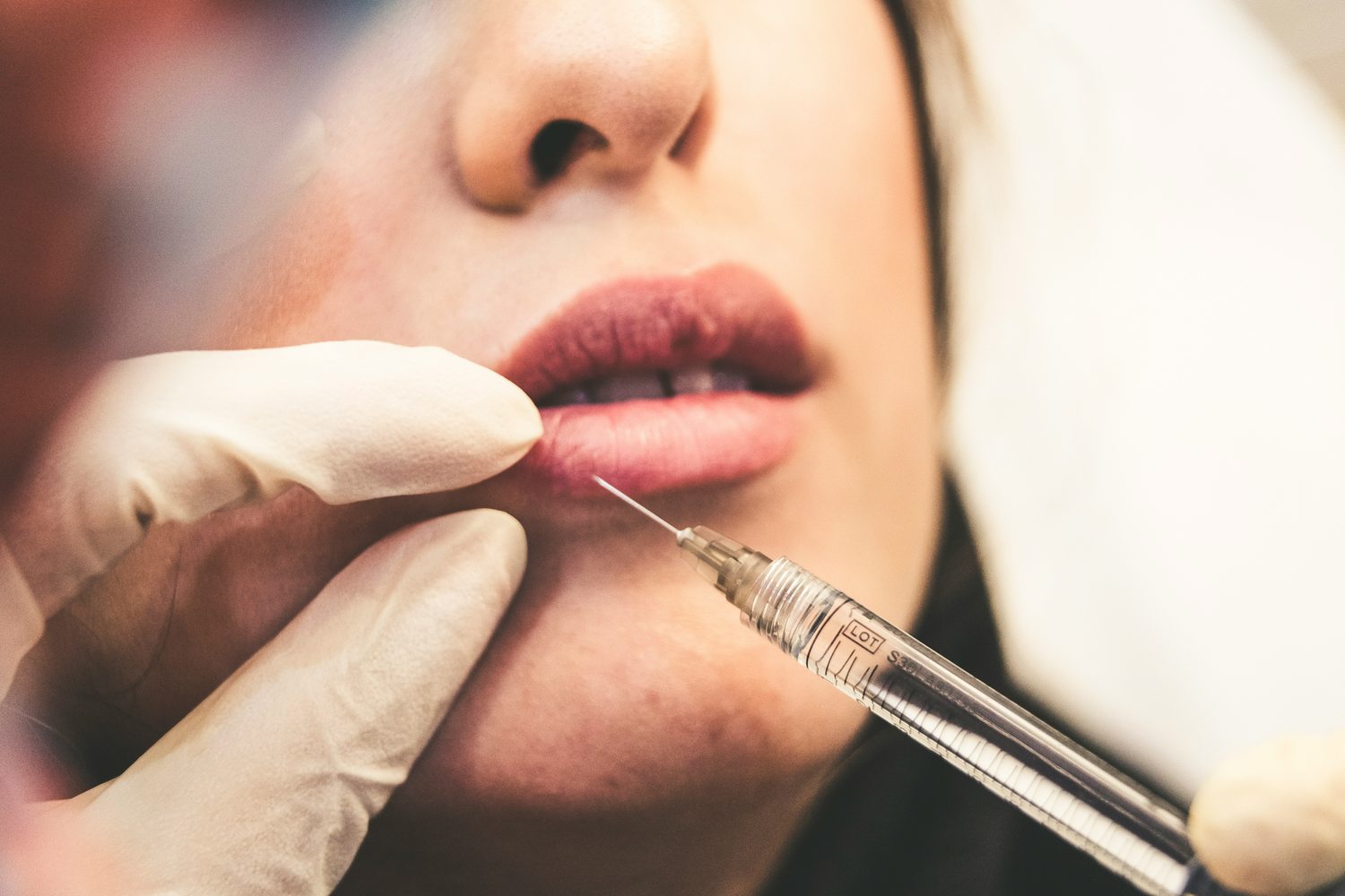 Close-up van een lipfillerbehandeling met een injectienaald bij de lip